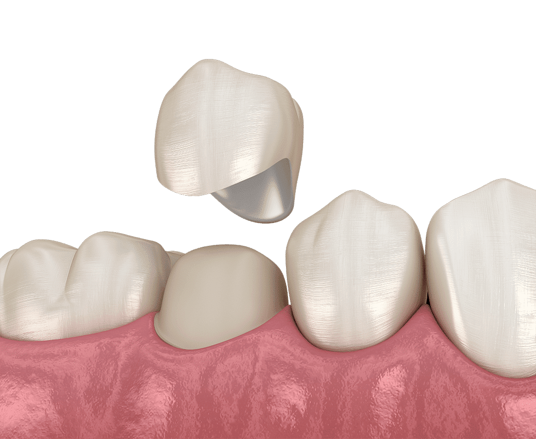 Las coronas dentales. Los dientes en la mandíbula superior, las